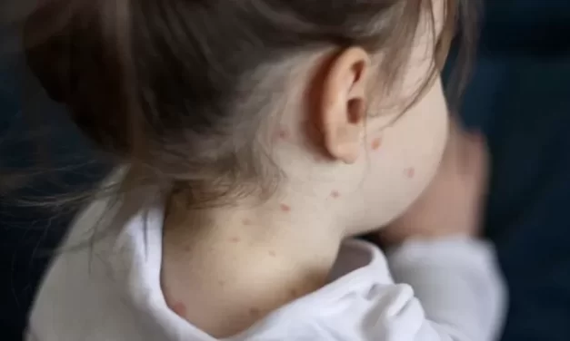 Negli Stati Uniti muore un’altra bambina di morbillo a causa dell’ideologia no-vax 