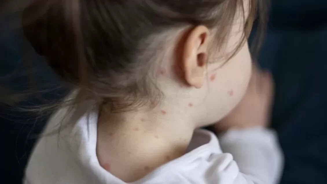 Negli Stati Uniti muore un’altra bambina di morbillo a causa dell’ideologia no-vax 